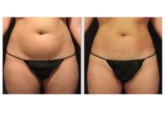 Velashape prima e dopo