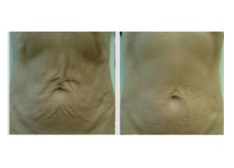 Velashape prima e dopo