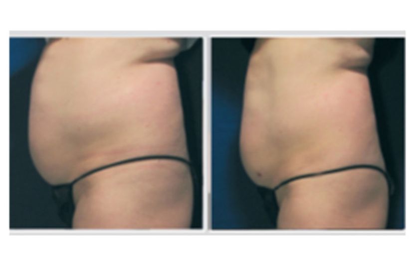 Velashape prima e dopo - 749994