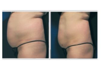 Velashape prima e dopo