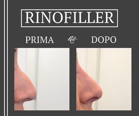 Rinofiller - Dott. Riccardo Accordi