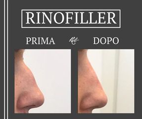 Rinofiller - Dott. Riccardo Accordi