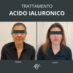 Acido ialuronico - Dott. Riccardo Accordi