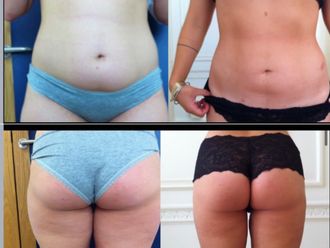 Liposcultura prima e dopo - 870694