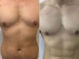 Liposcultura prima e dopo - 870701