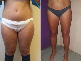 Liposcultura prima e dopo - 870704