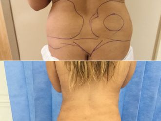 Liposcultura prima e dopo - 870707