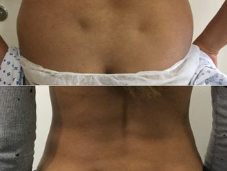 Liposcultura prima e dopo - 870708