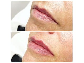 Filler labbra  -Dott.ssa Paola Nardolillo