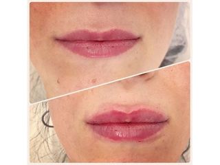 Filler labbra - Dott.ssa Paola Nardolillo