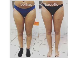 Carbossiterapia - Dott.ssa Paola Nardolillo