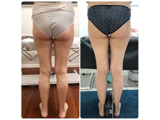 Carbossiterapia - Dott.ssa Paola Nardolillo