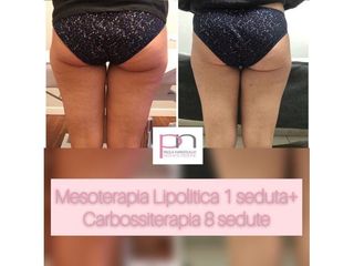 Mesoterapia - Dott.ssa Paola Nardolillo