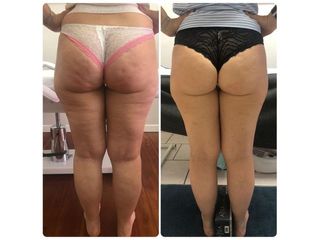 Carbossiterapia - Dott.ssa Paola Nardolillo
