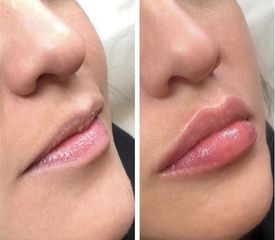 Filler Labbra prima e dopo