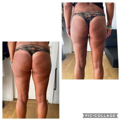 Cellulite prima e dopo