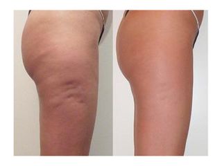 Cellulite - Dott.Di Molfetta Pasquale