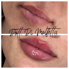 Filler labbra - Dott.Di Molfetta Pasquale