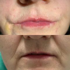 Filler labbra e naso geniene - Dott.ssa Olena Nazarko - DioDent Clinic