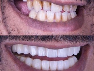 Faccette dentali - 845880