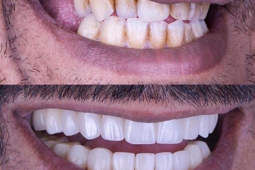 Faccette dentali prima e dopo - 845880