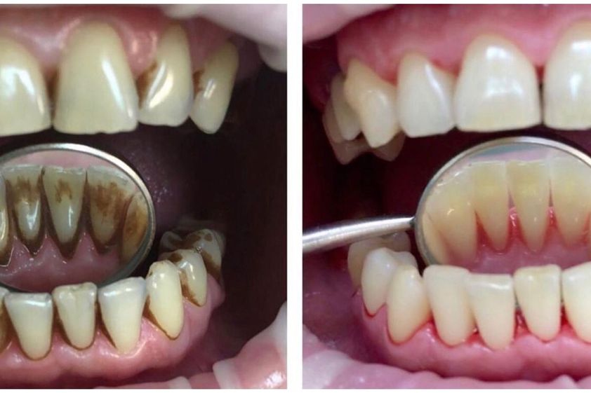 Sbiancamento denti prima e dopo - 847576