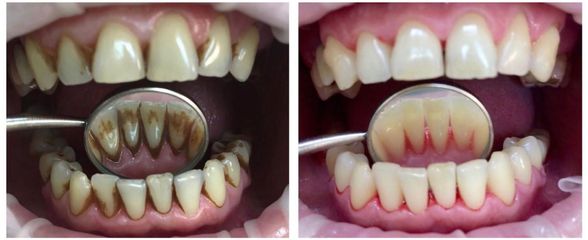Sbiancamento denti - Dott.ssa Olena Nazarko - DioDent Clinic