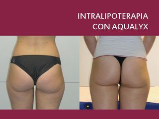 Intralipoterapia prima dopo