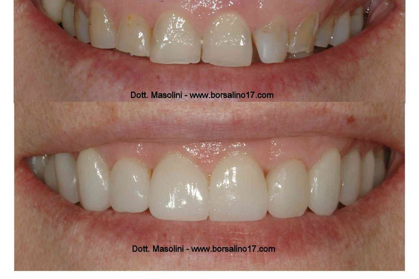 Faccette dentali prima e dopo - 746806