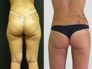 Liposuzione localizzata prima e dopo