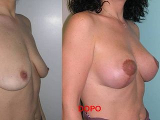 Mastopessi prima e dopo