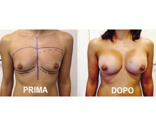 Mastoplastica additiva prima e dopo