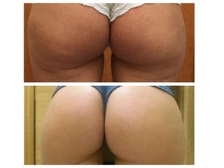 filler di biorivitalizzazione prima dopo