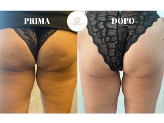 Cellulite prima e dopo - 870062