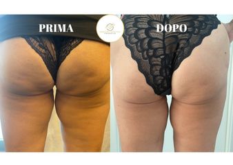 Cellulite - Dott.ssa Simona Pomarico