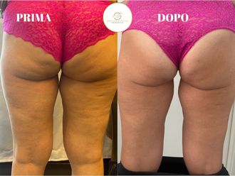 Cellulite prima e dopo - 870064