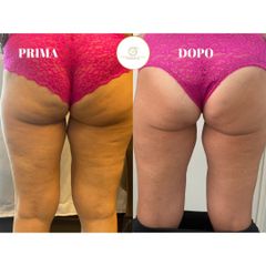 Cellulite - Dott.ssa Simona Pomarico