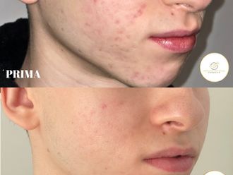 Acne prima e dopo - 870070