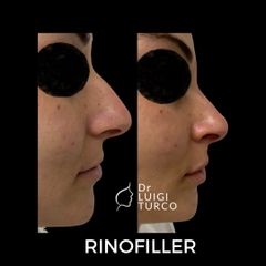 Rinofiller - Dott. Luigi Turco