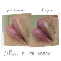 Filler labbra - Dott. Luigi Turco