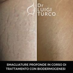 Smagliature - Dott. Luigi Turco