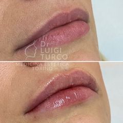 Filler labbra - Dott. Luigi Turco