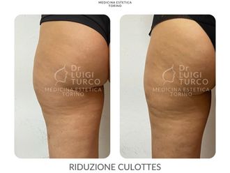Cavitazione prima e dopo - 831201
