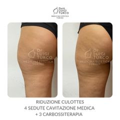 Cavitazione - Dott. Luigi Turco