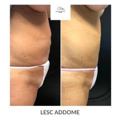 LESC addome - Dott. Luigi Turco