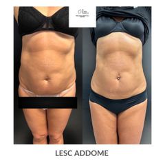 Cellulite - Dott. Luigi Turco