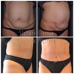 Addominoplastica - Dr. Roberto Loche