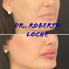 Filler labbra  - Dr. Roberto Loche