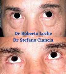 Blefaroplastica non chirurgica - Dr. Roberto Loche