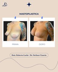 Dr. Roberto Loche Mastoplastica additiva